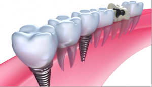 Dental Implants Rockville MD